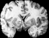 Malignant cerebral edema secondary to traumatic head injury
